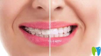 李永信醫(yī)生在矯正牙齒同時(shí)注重塑造美麗笑線(xiàn)