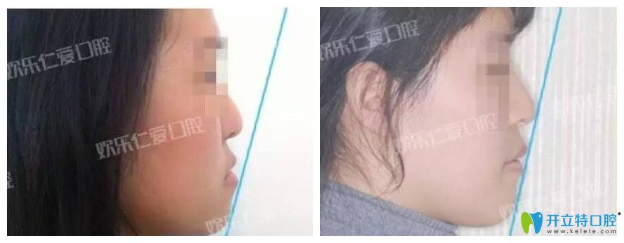 歡樂(lè)仁愛口腔骨性反合的掩飾性治療案例