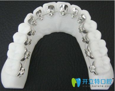 南昌輝煌口腔丁圣剛介紹舌側(cè)牙齒矯正技術(shù)優(yōu)勢