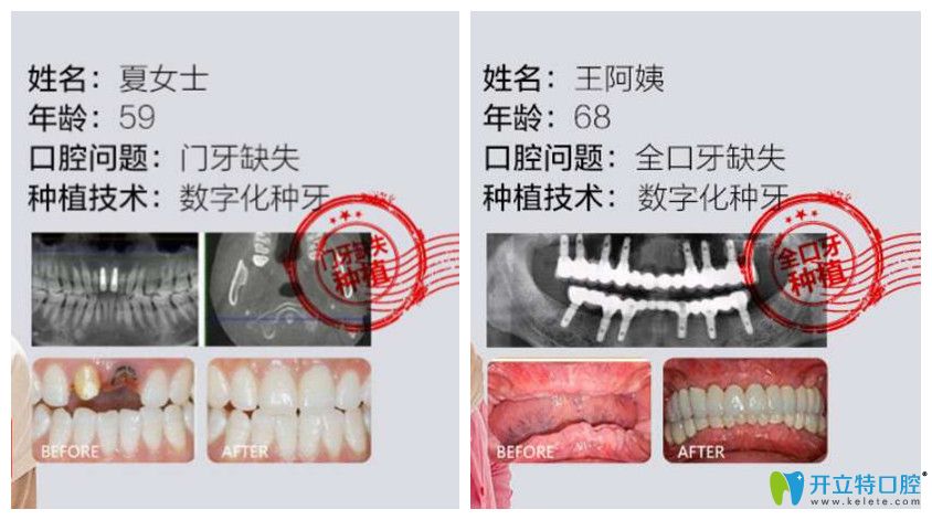 德韓口腔門(mén)牙種植+全口牙缺失種植案例效果對(duì)比