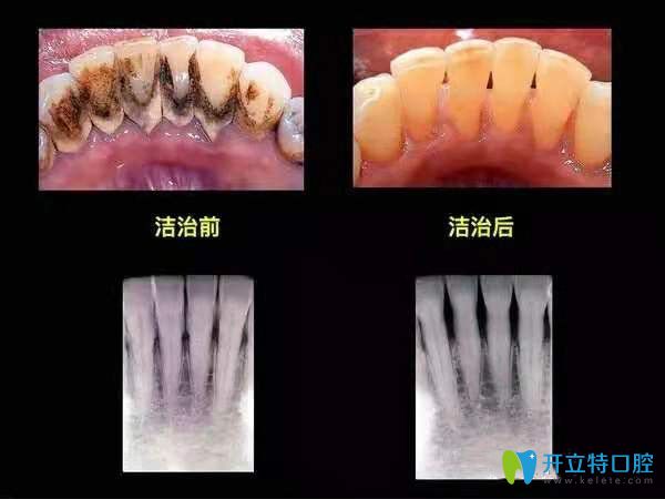 360度超聲波深層潔牙前后對(duì)比圖