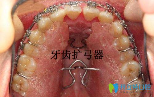 本想擴(kuò)弓改變嘴凸,有人說牙齒擴(kuò)弓后會更凸,真的嗎