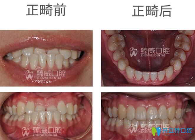 小姐姐矯正地包天后不僅牙齒變整齊了，臉型也有了很大的改變