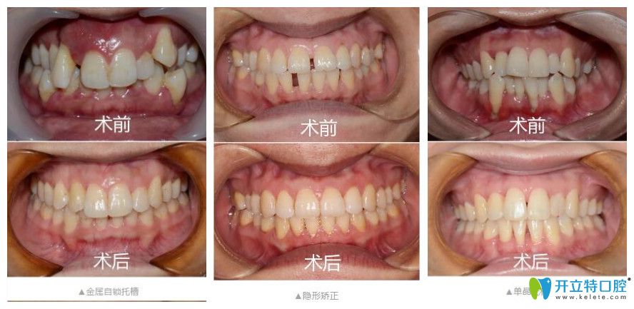寧波恒美口腔做矯正怎么樣？矯正價(jià)格不貴技術(shù)好