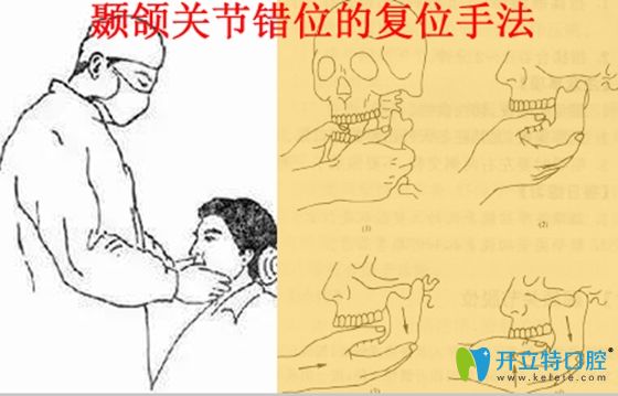 顳頜關節(jié)錯位的復位治療手法圖