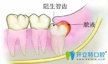 不要再糾結(jié)智齒冠周炎能自愈嗎?教你三個方法輕松治療疼痛