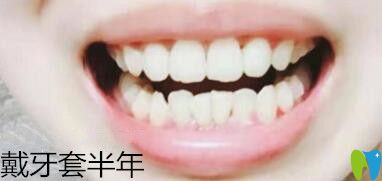 我在深圳諾德口腔做牙齒矯正6個月
