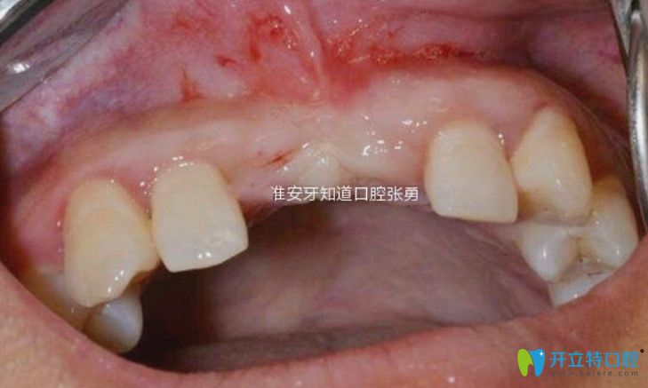 淮安哪里做種植牙好？顧客反饋淮安牙知道張勇種牙水平高