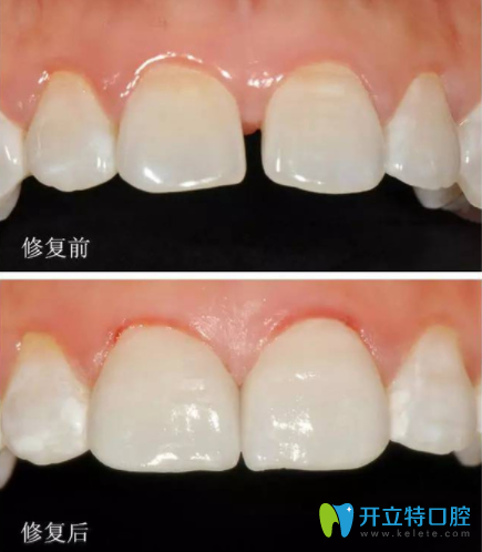 牙齒超薄貼面怎么樣？多少錢一顆？也許這個是你更關(guān)心的