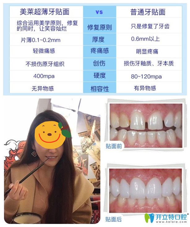 美萊超薄牙貼面你無悔的選擇，小姐姐來曬牙貼面后對比照