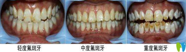 氟斑牙的美白方法大全并附價格表，看看哪種省錢又適合你