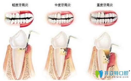 美奧口腔全口牙周治療價(jià)格