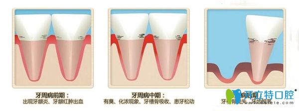 牙周病不同時期的癥狀