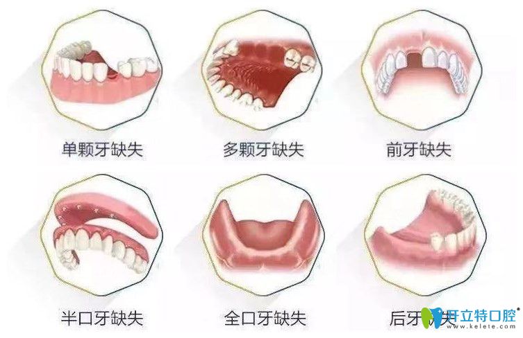 石家莊中諾口腔種植牙征集人群
