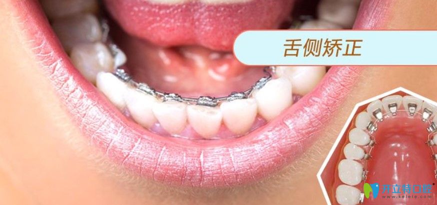 楊春犁醫(yī)生講解為什么很少人做舌側矯正