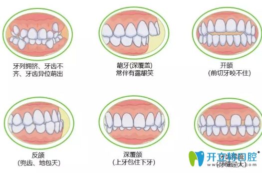 常見(jiàn)牙齒不齊的幾種癥狀