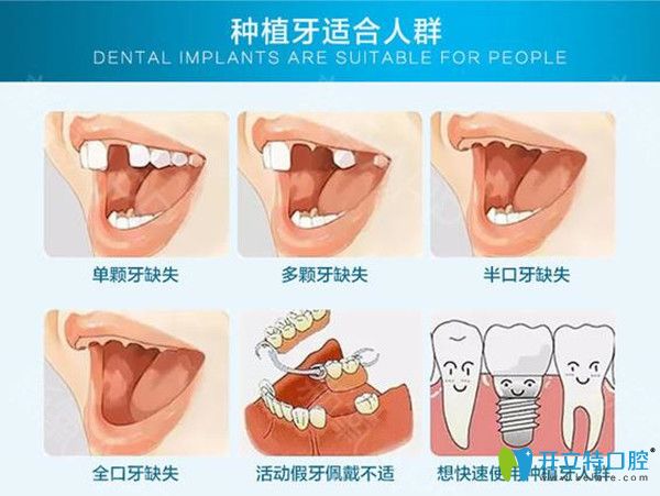 種植牙適宜人群