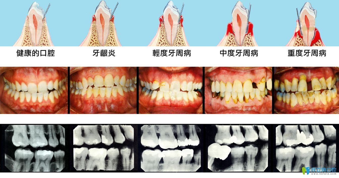 牙周炎牙齒松動(dòng)怎么辦,需不需要拔牙要看能否固定恢復(fù)