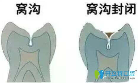 窩溝封閉