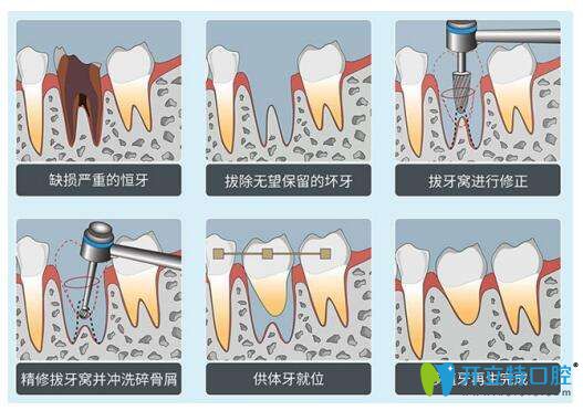 自體牙移植