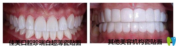 珍瑞白瓷貼面與其他機構瓷貼面對比