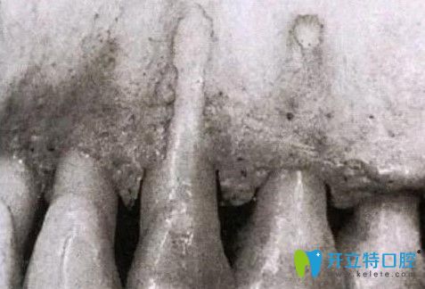 漲姿勢(shì):正畸發(fā)生骨開窗幾率大嗎?如果牙槽骨開窗怎么治療?