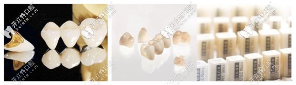 牙齒缺損了做烤瓷牙還是瓷?？贪?做過的說說哪個好