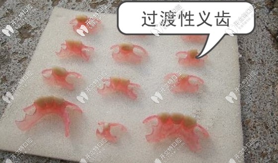 誰知道種植牙的過渡義齒能用多久呢?若長期佩戴可以嗎？