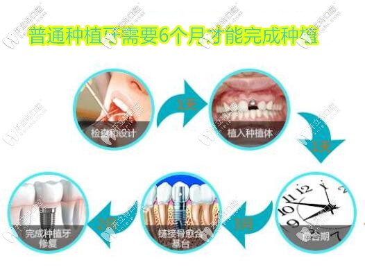 種植牙過(guò)程圖解