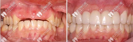 種植牙前后對比圖