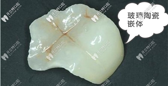 從玻璃陶瓷嵌體的優(yōu)缺點和價格來分析這個牙嵌體怎么樣?