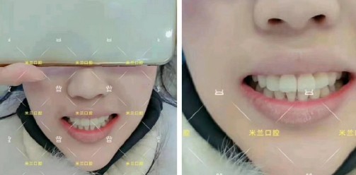 直到多生牙把門牙都擠變形了，才決定拔牙帶3M自鎖牙套矯正