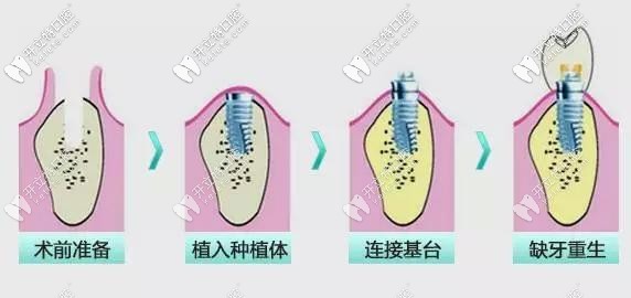 種植牙過程