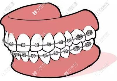 原來傳統(tǒng)鋼絲矯正一副多少錢，跟牙套上的弓絲有關啊