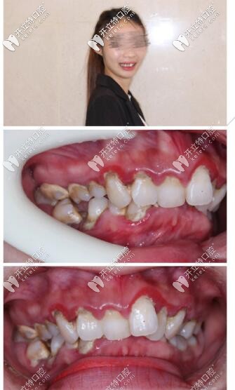 牙不齊深覆合3m自鎖托槽矯正5個月,點贊海口這家高大上牙科