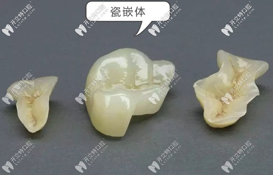 在三亞的補牙收費參考價格