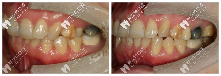 從側(cè)面照更能看出來牙齒原本的問題