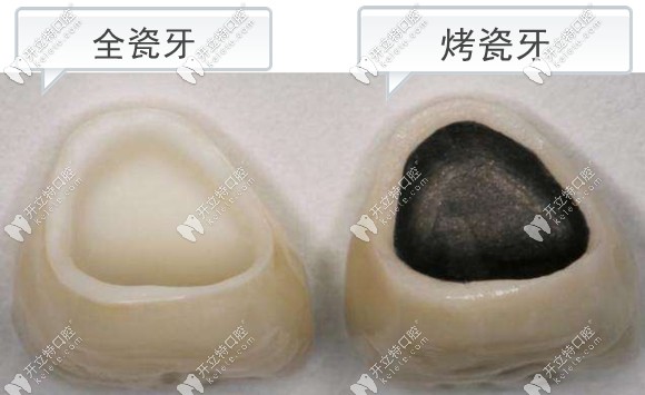 全瓷牙冠和烤瓷牙冠的比較