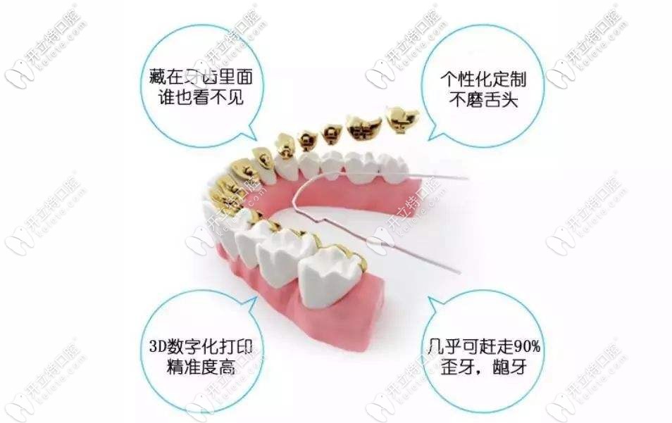 舌側隱形矯正優(yōu)勢圖