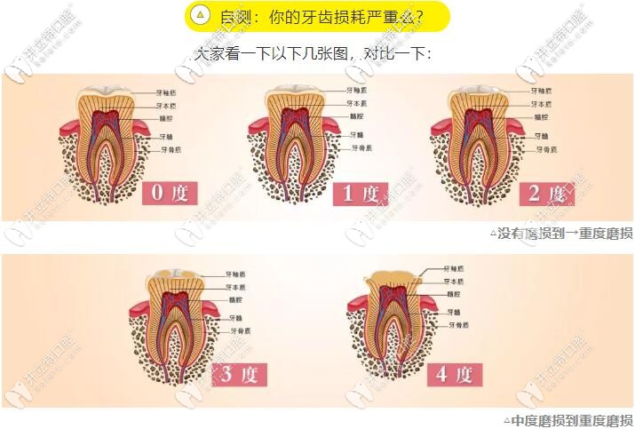 牙齒磨耗的程度