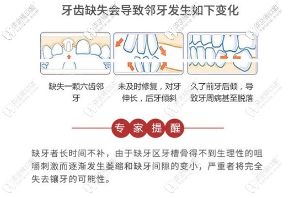 牙齒缺失，千萬不要輕忽