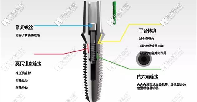 選擇種植牙，方方面面都要考慮到位