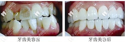沈陽(yáng)百嘉麗口腔牙齒美容案例
