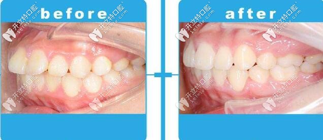 沈陽(yáng)百嘉麗口腔牙齒矯正案例