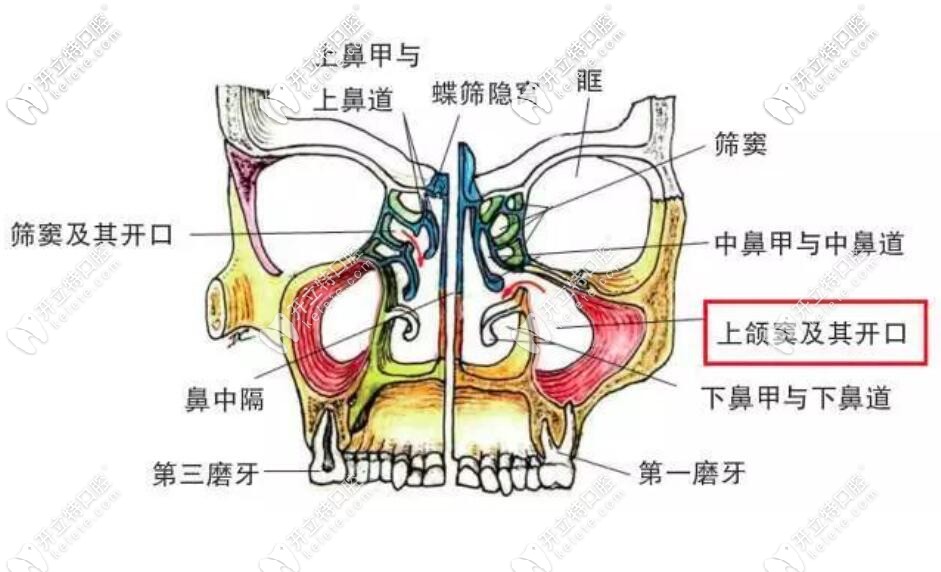 答疑:怎么判斷上頜竇穿孔？種植牙上頜竇穿透了會(huì)自愈嗎？