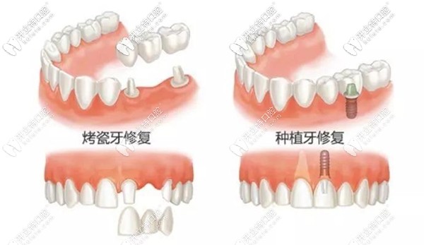 種植牙和傳統(tǒng)鑲牙對比圖
