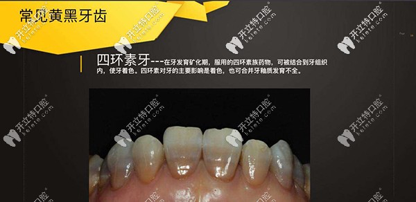 做四環(huán)素牙牙齒漂白多少錢？做出來不知道效果好不好？