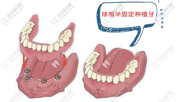廊坊愛(ài)嘉口腔半口球帽半固定種植牙