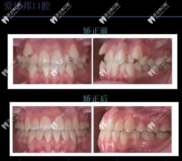 反頜矯正 婁底愛(ài)牙邦口腔醫(yī)院
