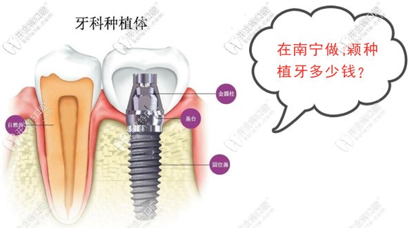 南寧做1顆種植牙的價(jià)格是多少錢?韓系和歐美進(jìn)口的種植體